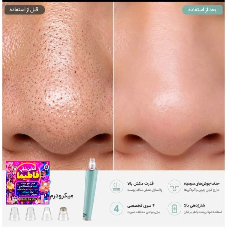 میکرودرم مخزن دار باکیفیت