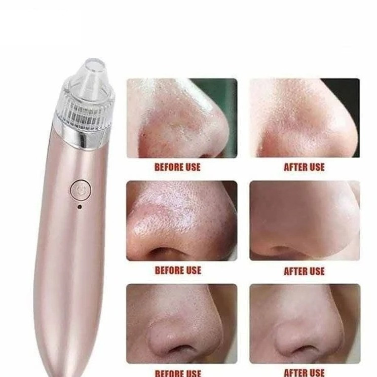 دستگاه میکرودرم خانگی مدل XN-8030