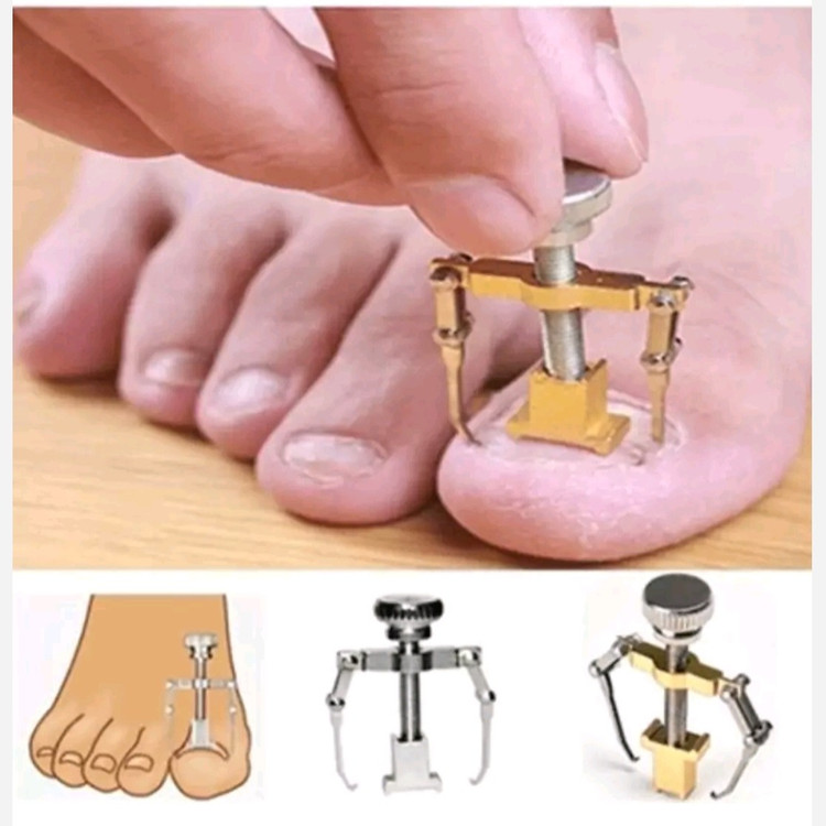 ارتودنسی ناخن ابزار اصلاح ناخن دستگاه ترمیم ناخن پا